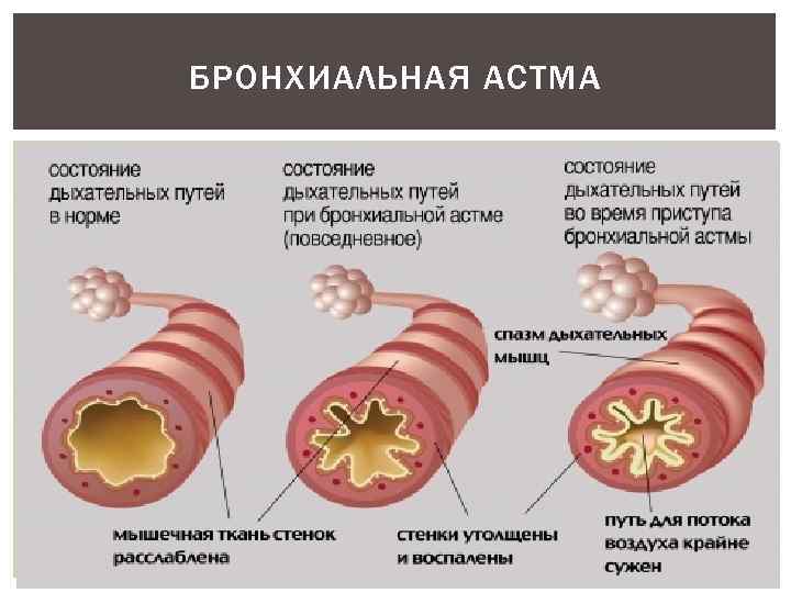 БРОНХИАЛЬНАЯ АСТМА 