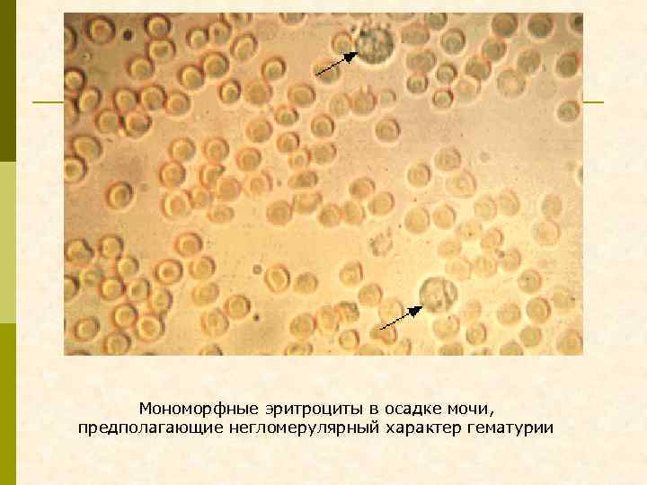 Появление эритроцитов в моче. Эритроциты в моче микроскопия. Неизмененные эритроциты в моче микроскопия. Эритроциты в моче микроскопия осадка. Измененные эритроциты в моче под микроскопом.