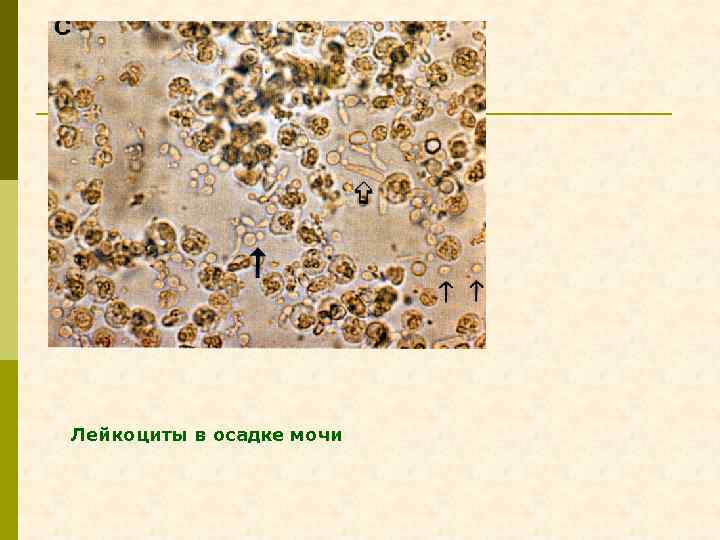 Какого цвета песок в моче фото без микроскопа