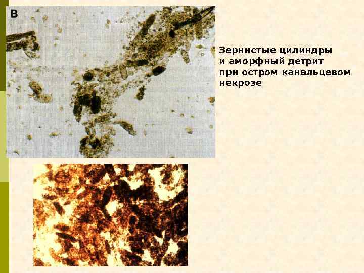 Детрит это. Зернистые цилиндры. Детрит. Зернистые цилиндры в моче.