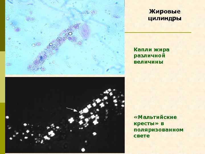 Жировой цилиндр в моче фото