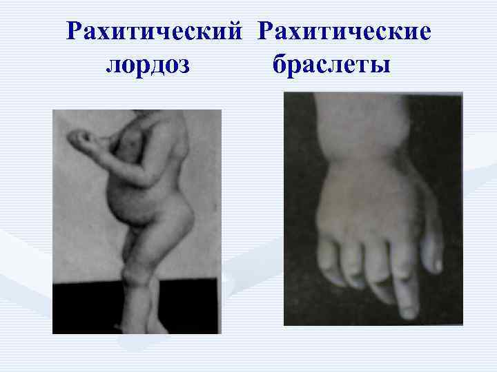 Рахитический Рахитические лордоз браслеты 