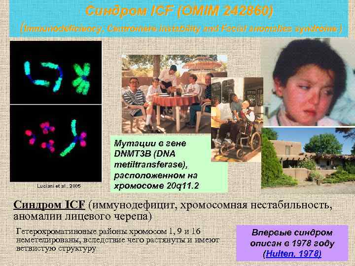 Синдром ICF (OMIM 242860) (Immunodeficiency, Centromere instability and Facial anomalies syndrome ) Luciani et