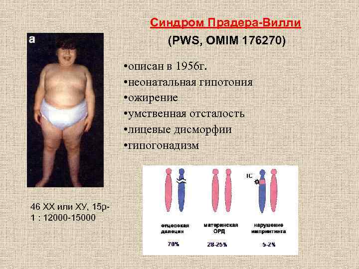 Синдром Прадера-Вилли (PWS, OMIM 176270) • описан в 1956 г. • неонатальная гипотония •