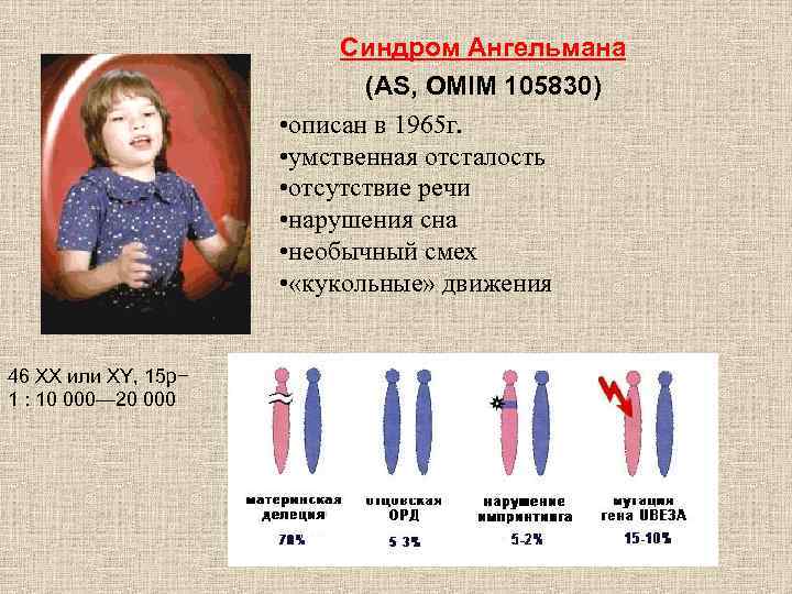 Синдром Ангельмана (AS, OMIM 105830) • описан в 1965 г. • умственная отсталость •