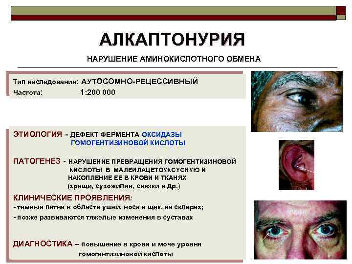 АЛКАПТОНУРИЯ НАРУШЕНИЕ АМИНОКИСЛОТНОГО ОБМЕНА Тип наследования: АУТОСОМНО-РЕЦЕССИВНЫЙ Частота: 1: 200 000 ЭТИОЛОГИЯ - ДЕФЕКТ