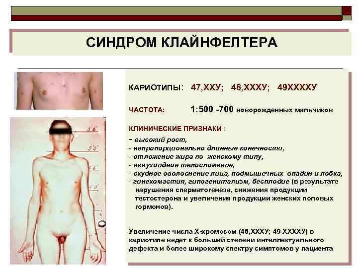 СИНДРОМ КЛАЙНФЕЛТЕРА КАРИОТИПЫ: 47, ХХУ; 48, ХХХУ; 49 ХХХХУ ЧАСТОТА: 1: 500 -700 новорожденных