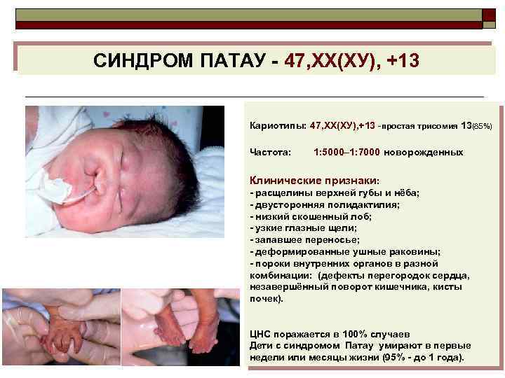 СИНДРОМ ПАТАУ - 47, ХХ(ХУ), +13 Кариотипы: 47, ХХ(ХУ), +13 -простая трисомия 13(85%) Частота: