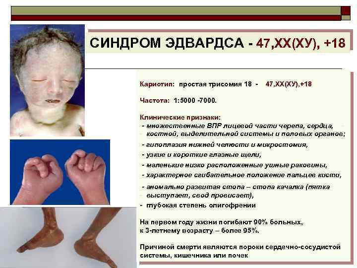 СИНДРОМ ЭДВАРДСА - 47, ХХ(ХУ), +18 Кариотип: простая трисомия 18 - 47, ХХ(ХУ), +18