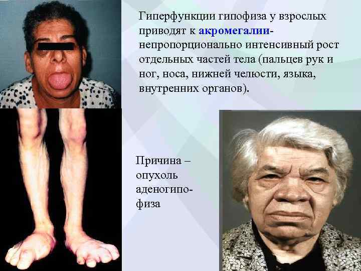 Гиперфункции гипофиза у взрослых приводят к акромегалии- непропорционально интенсивный рост отдельных частей тела (пальцев