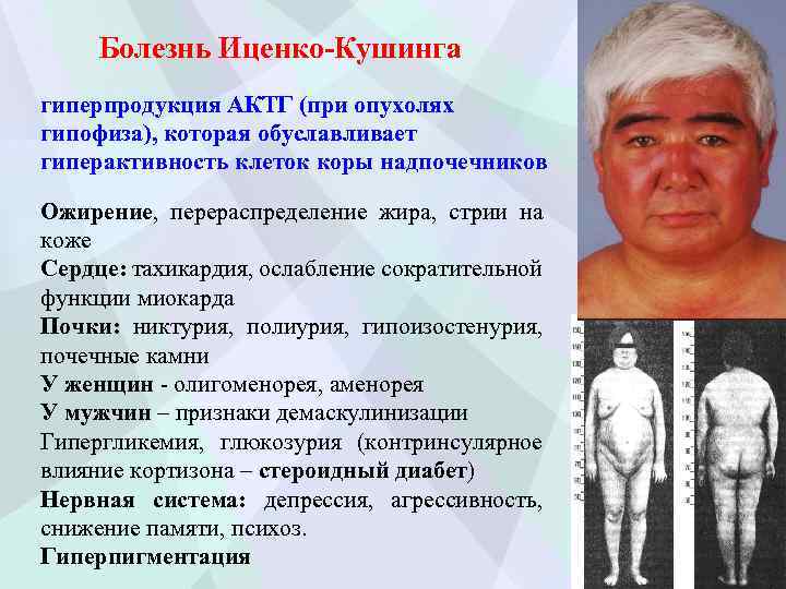 Болезнь Иценко-Кушинга гиперпродукция АКТГ (при опухолях гипофиза), которая обуславливает гиперактивность клеток коры надпочечников Ожирение,