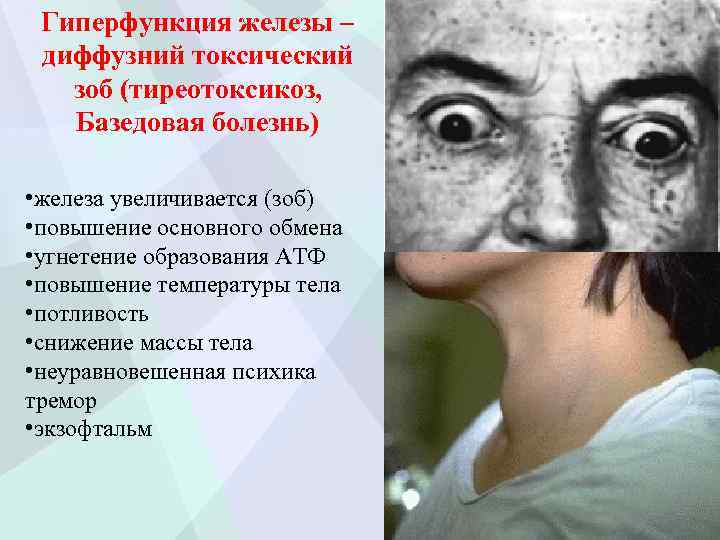 Гиперфункция железы – диффузний токсический зоб (тиреотоксикоз, Базедовая болезнь) • железа увеличивается (зоб) •