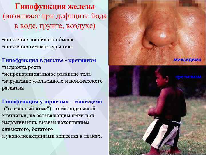 Гипофункция железы (возникает при дефиците йода в воде, грунте, воздухе) • снижение основного обмена