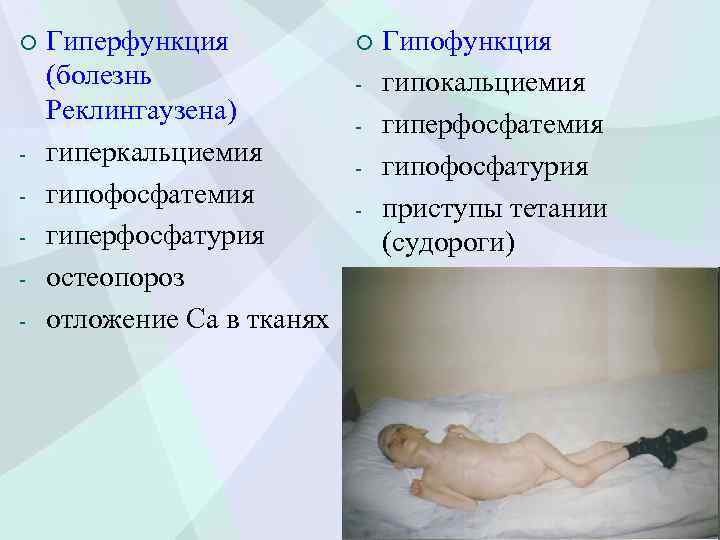 ¡ - Гиперфункция (болезнь Реклингаузена) гиперкальциемия гипофосфатемия гиперфосфатурия остеопороз отложение Са в тканях ¡