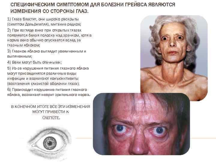 СПЕЦИФИЧЕСКИМ СИМПТОМОМ ДЛЯ БОЛЕЗНИ ГРЕЙВСА ЯВЛЯЮТСЯ ИЗМЕНЕНИЯ СО СТОРОНЫ ГЛАЗ. 1) Глаза блестят, они