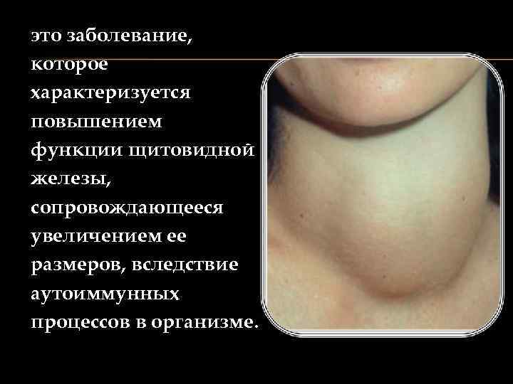 это заболевание, которое характеризуется повышением функции щитовидной железы, сопровождающееся увеличением ее размеров, вследствие аутоиммунных