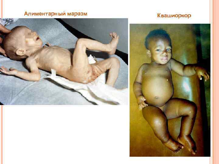 Алиментарный маразм Квашиоркор 