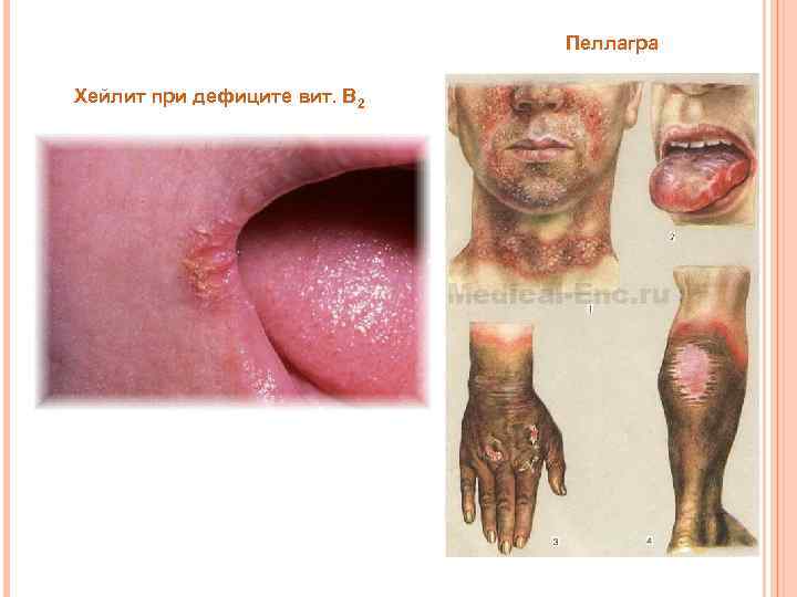 Пеллагра Хейлит при дефиците вит. В 2 