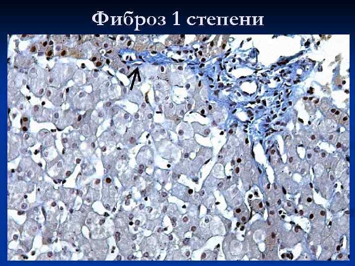 Фиброз 1 степени 
