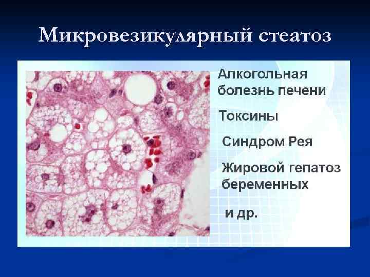 Микровезикулярный стеатоз 
