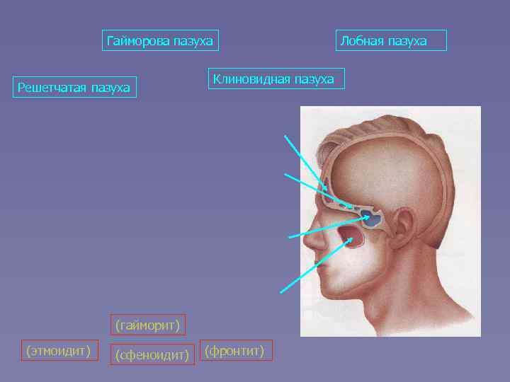 Гайморова пазуха Решетчатая пазуха Лобная пазуха Клиновидная пазуха (гайморит) (этмоидит) (сфеноидит) (фронтит) 