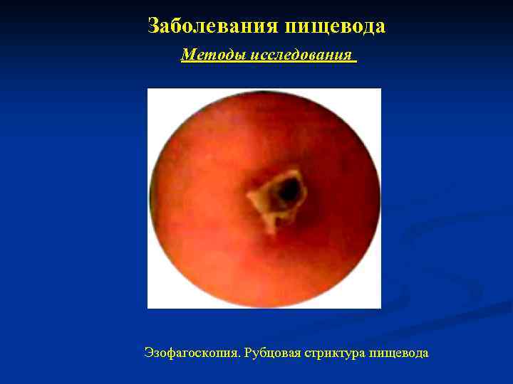 Заболевания пищевода Методы исследования Эзофагоскопия. Рубцовая стриктура пищевода 