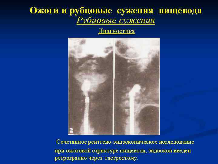 Ожоги и рубцовые сужения пищевода Рубцовые сужения Диагностика Сочетанное рентгено-эндоскопическое исследование при ожоговой стриктуре