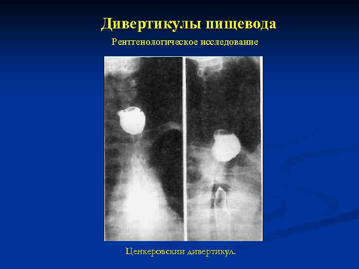 Дивертикулы пищевода Рентгенологическое исследование Ценкеровскии дивертикул. 