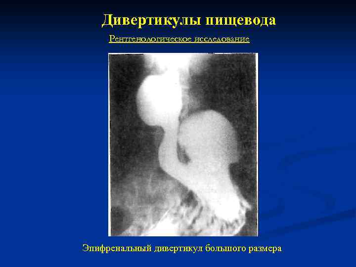 Дивертикулы пищевода Рентгенологическое исследование Эпифренальный дивертикул большого размера 