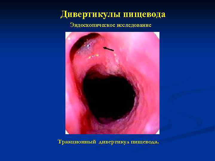 Дивертикулы пищевода Эндоскопическое исследование Тракционный дивертикул пищевода. 