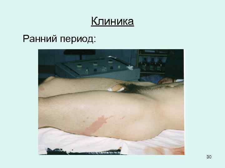 Клиника Ранний период: 30 