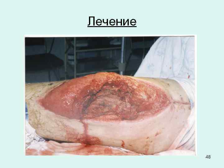 Лечение 48 