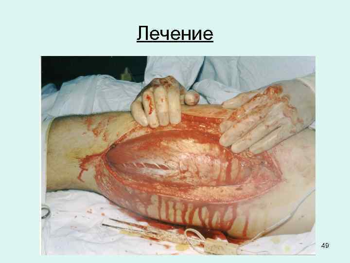 Лечение 49 