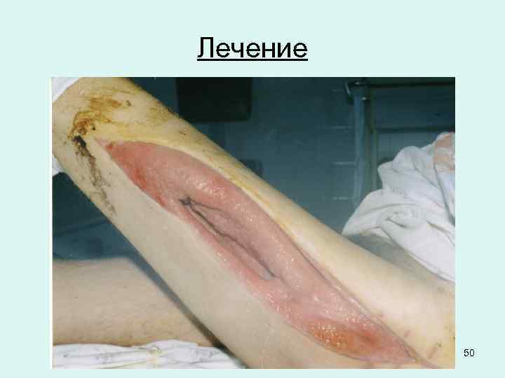 Лечение 50 