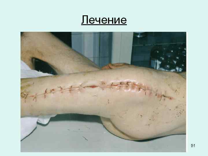 Лечение 51 