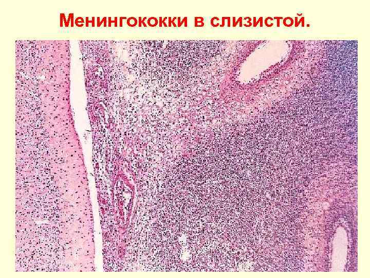 Менингококки в слизистой. 