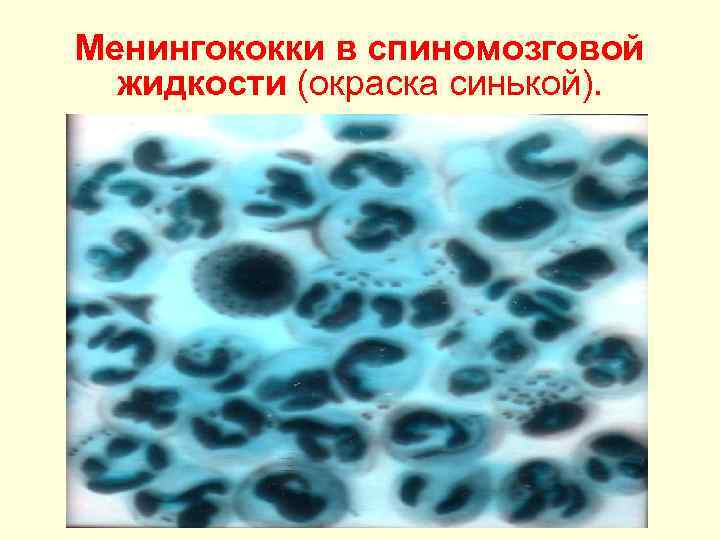 Менингококки в спиномозговой жидкости (окраска синькой). 