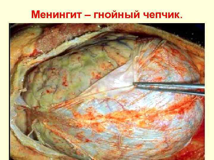 Менингит – гнойный чепчик. 