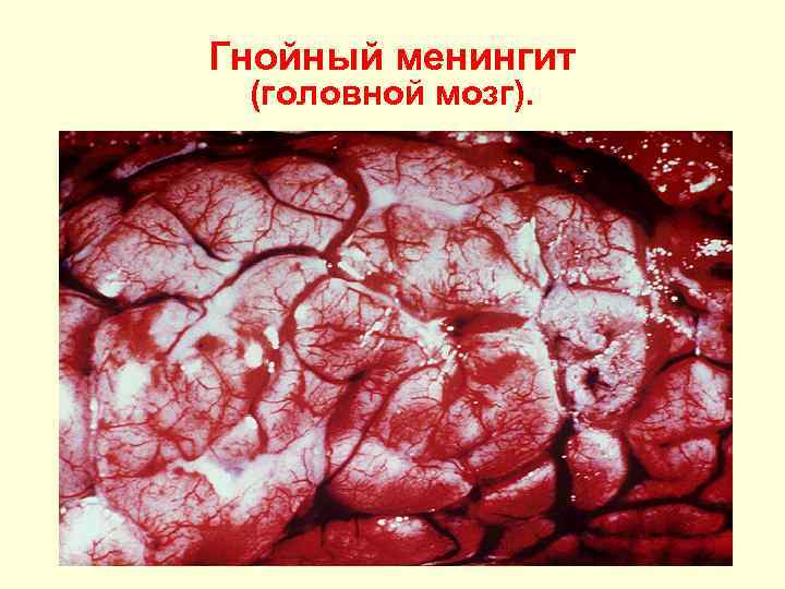 Гнойный менингит (головной мозг). 
