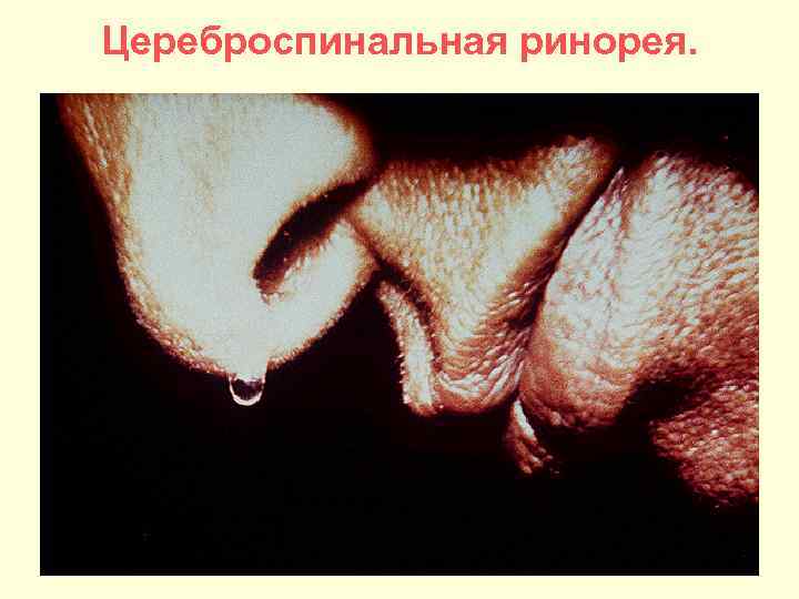Цереброспинальная ринорея. 