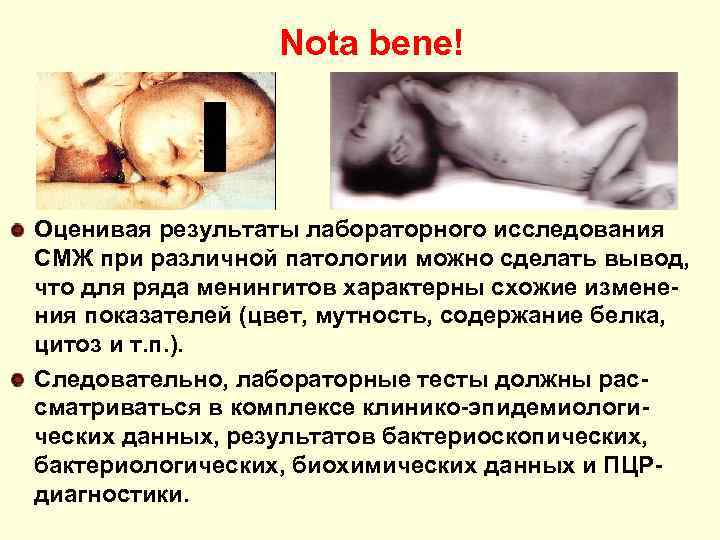 Nota bene! Оценивая результаты лабораторного исследования СМЖ при различной патологии можно сделать вывод, что