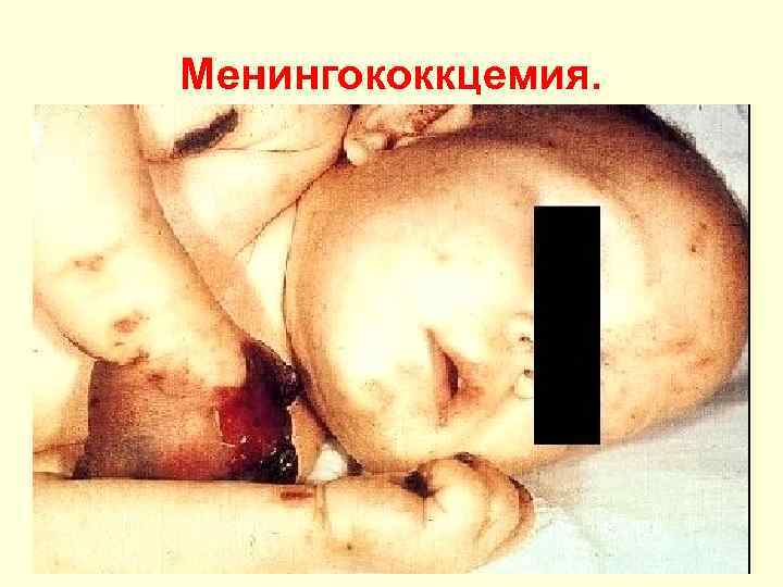 Менингококкцемия. 