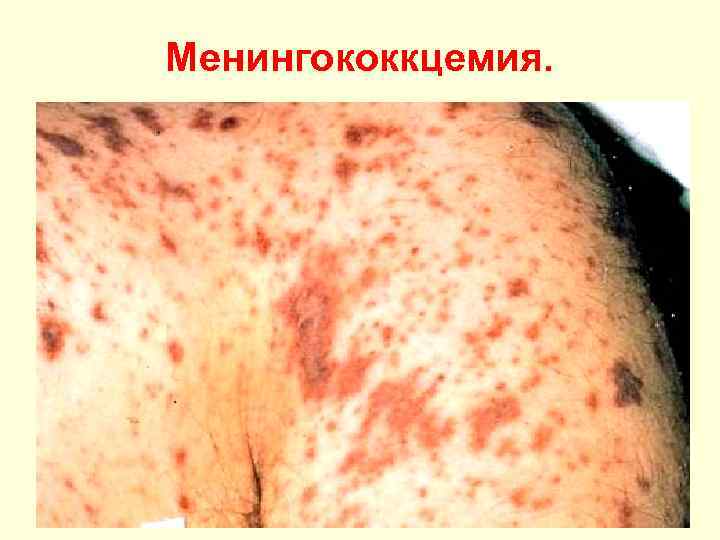 Менингококкцемия. 