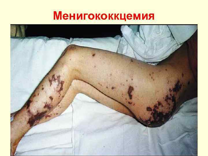 Менигококкцемия 