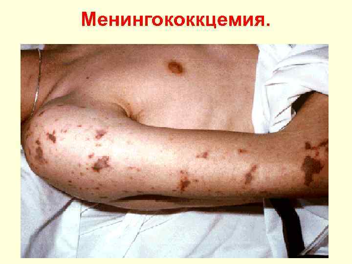 Менингококкцемия. 