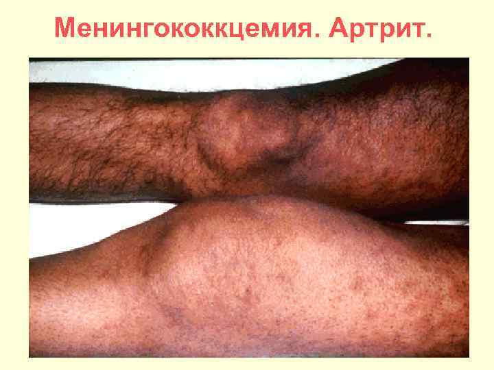 Менингококкцемия. Артрит. 