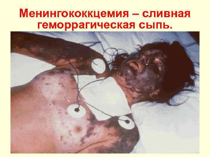 Менингококкцемия – сливная геморрагическая сыпь. 