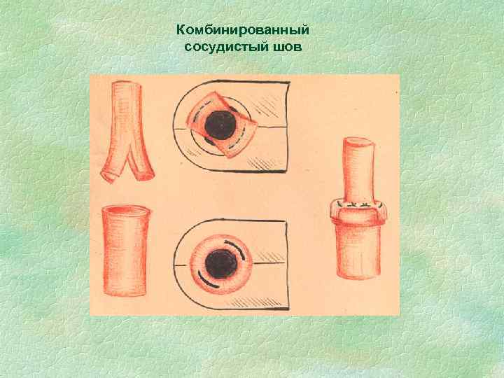 Комбинированный сосудистый шов 