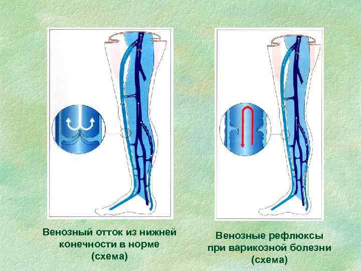 Венозный отток из нижней конечности в норме (схема) Венозные рефлюксы при варикозной болезни (схема)