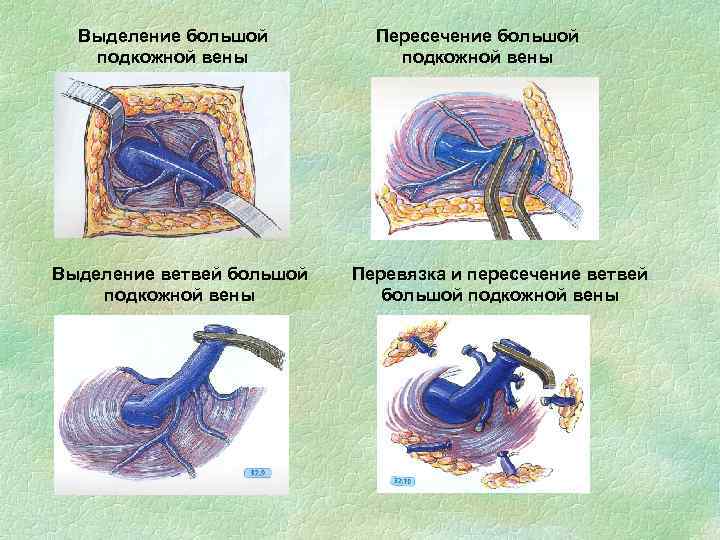 Выделение большой подкожной вены Выделение ветвей большой подкожной вены Пересечение большой подкожной вены Перевязка
